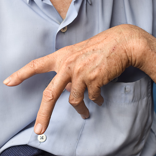 Finger ziehen sich aufgrund einer Dupuytren-Kontraktur zusammen.